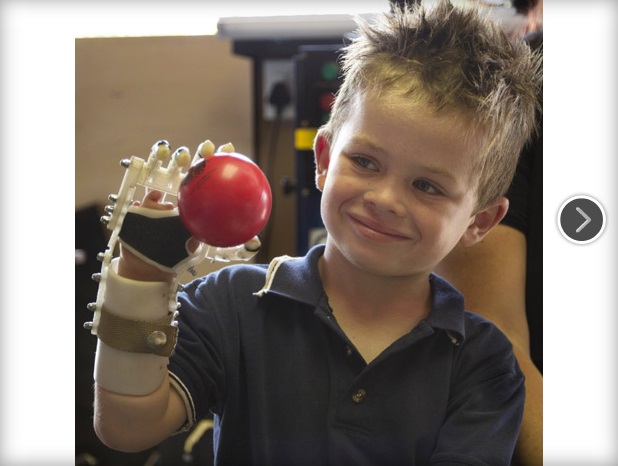 Tay giả từ máy in 3D giúp trẻ khuyết tật 
