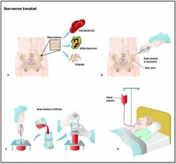  Các bước tiến hành ghép tuỷ.