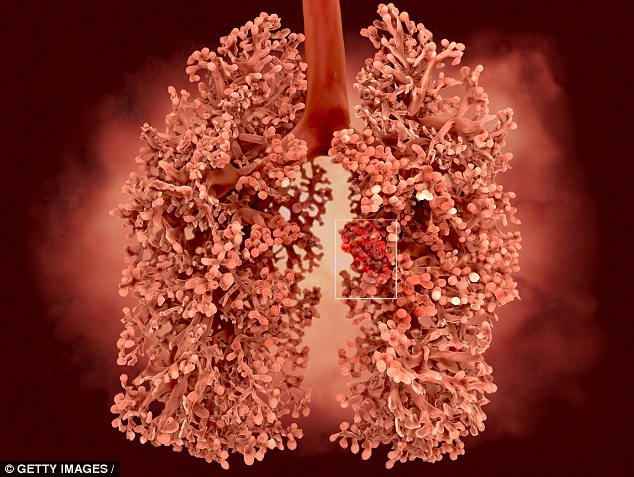  Ung thư phổi có thể được phát hiện trước 5 năm 