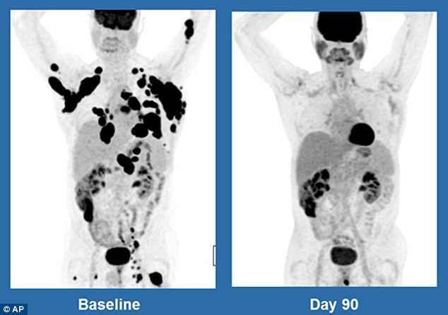 Hình ảnh quét cơ thể của một bệnh nhân 62 tuổi sau 3 tháng điều trị (màu đen thể hiện cho các khối u ung thư) 