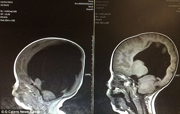  Ảnh chụp não khi Noah vừa được sinh ra (bên trái) và khi cậu đã 5 tuổi (bên phải). Bộ não đã hồi sinh một cách kỳ diệu 