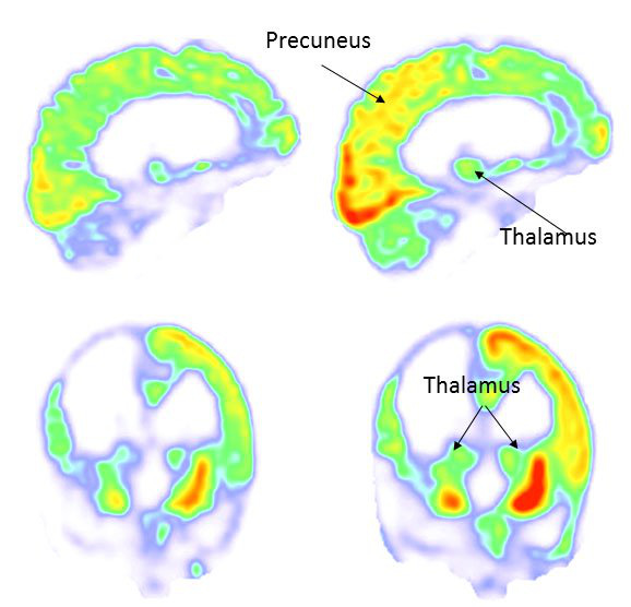  Trao đổi chất trong não bộ gia tăng sau khi thực hiện liệu pháp (bên phải so với bên trái)- ảnh chụp PET 
