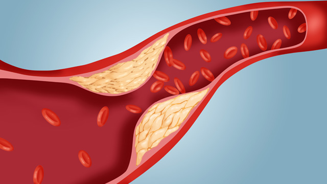  Cholesterol làm tắc mạch máu và gây đau tim, nhưng đó chỉ là một cái nhìn phiến diện 