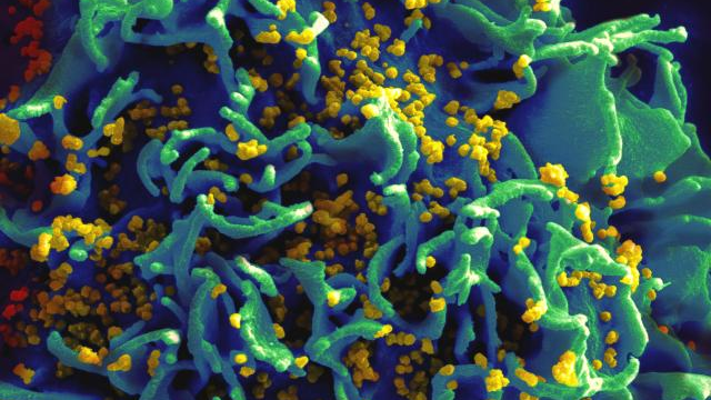  Hình ảnh hiển vi chụp các tế bào T bị nhiễm virus HIV 