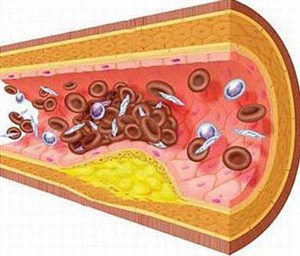 Xơ vữa động mạch gây ảnh hưởng nghiêm trọng tới việc lưu thông máu trong cơ thể