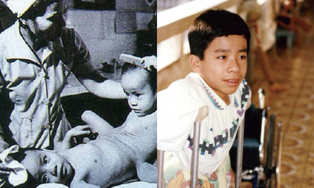  Nguyễn Đức trước và sau khi được phẫu thuật tách rời khỏi anh trai song sinh. 