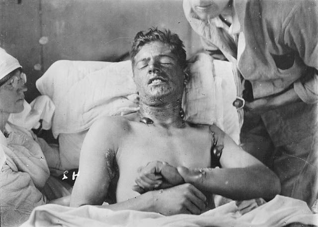  Người lính Canada bị ảnh hưởng bởi khí gas mù tạt. 