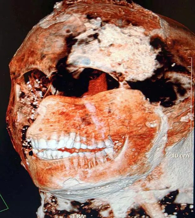  Một hình ảnh quét CAT cho thấy hàm răng của người La Mã cổ đại cực kỳ khỏe mạnh 