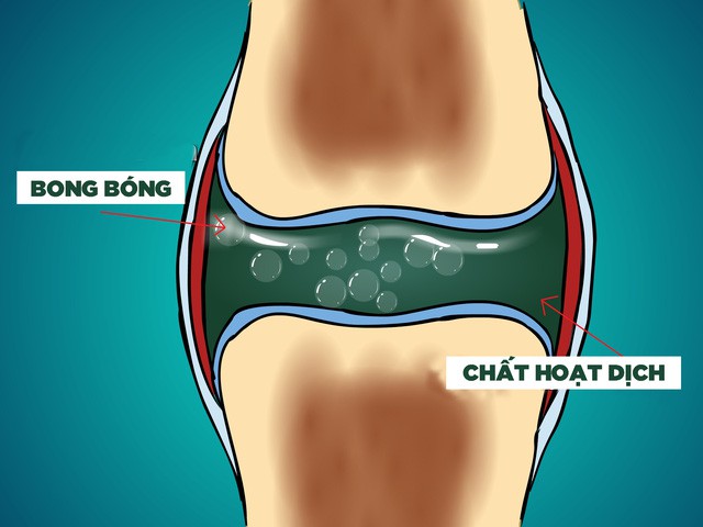  Những bong bóng trong chất hoạt dịch là nguồn gốc của tiếng lục khục khi bẻ khớp 