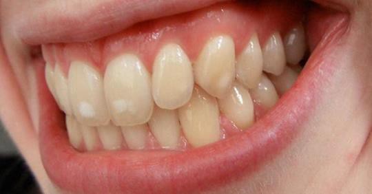 Răng của bạn có đốm trắng kỳ lạ này? Đây là lý do chúng xuất hiện - Ảnh 1.