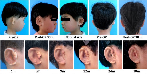 5 bệnh nhi đầu tiên trên thế giới được phẫu thuật ghép tai kiểu copy/paste 