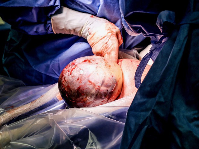 Hiếm thấy trong 80.000 ca sinh: bé gái chào đời với màng ối trùm quanh đầu - Ảnh 2.