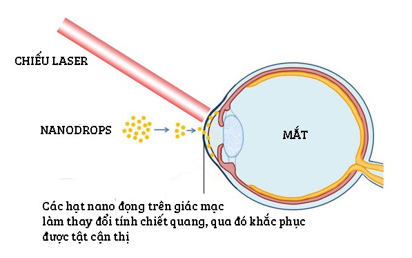 Phương pháp điều trị cận thị với nước nhỏ mắt Nanodrops 