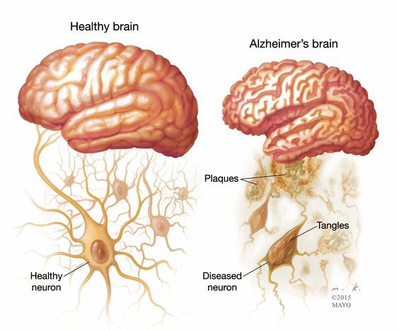 
Bên trái là bộ não khỏe mạnh, bên phải là bộ não bị Alzheimer, với các plaque là các mảng bám protein.
