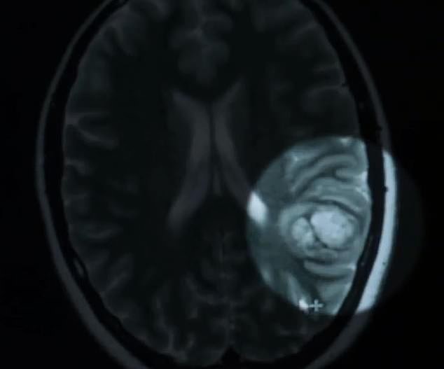 Cô gái 25 tuổi tỉnh táo livestream trong ca phẫu thuật não của chính mình - Ảnh 3.