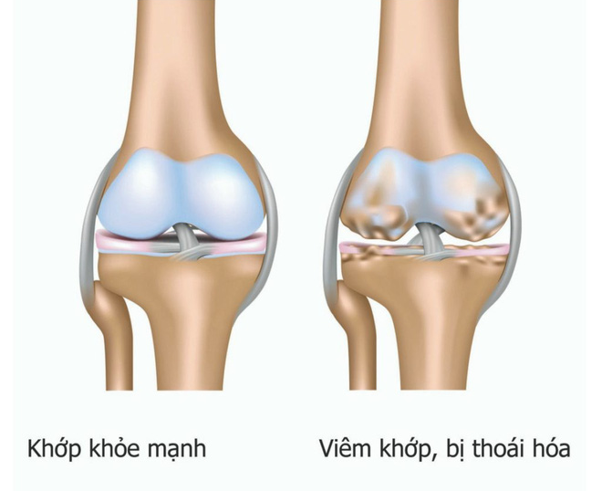 Đừng chủ quan khi đau nhức xương khớp, cẩn thận dấu hiệu ung thư xương dễ bị nhầm lẫn - Ảnh 2.