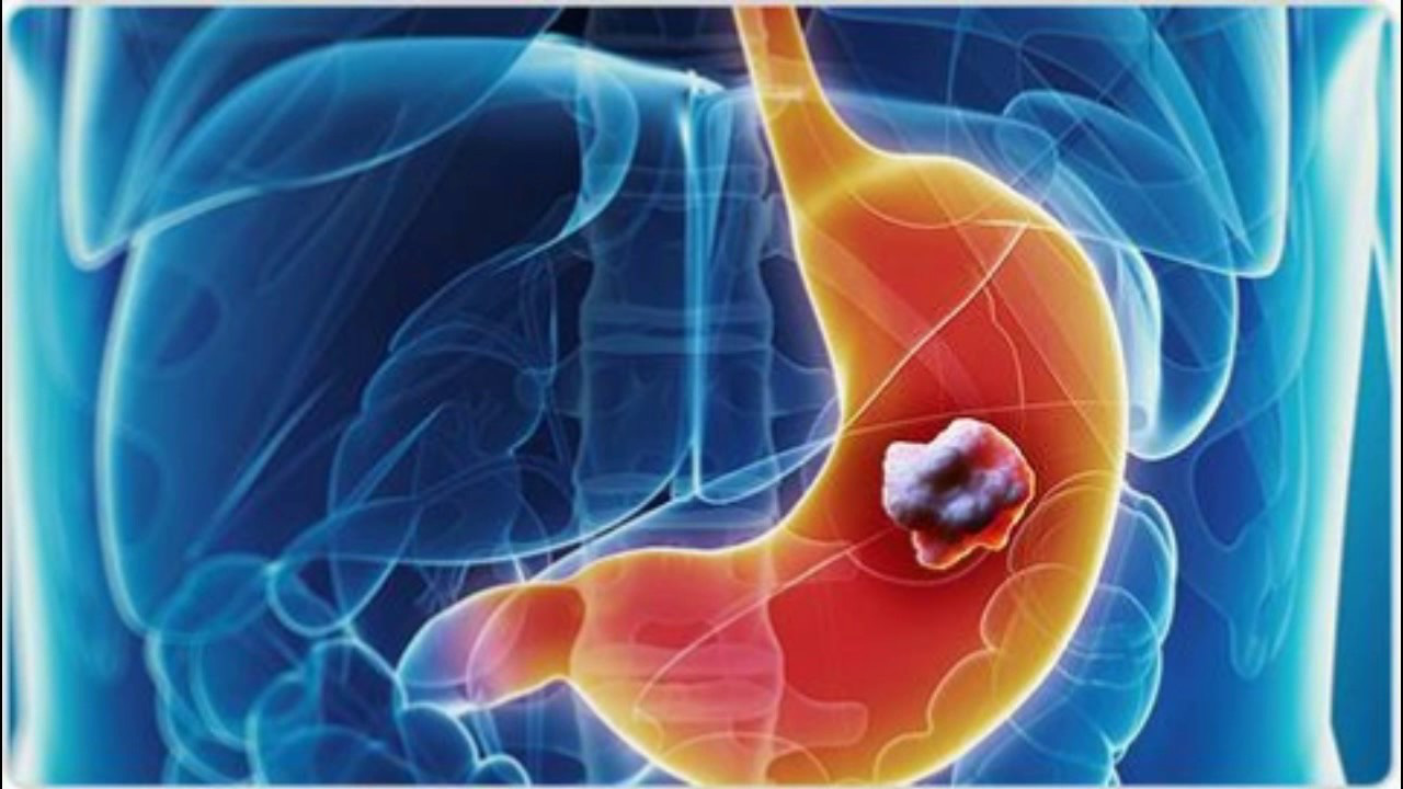 Nóng rát bụng: Cẩn thận với dấu hiệu sớm của ung thư dạ dày - Ảnh 4. Nóng rát bụng: Cẩn thận với dấu hiệu sớm của ung thư dạ dày - Ảnh 4.