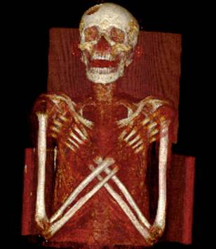 Căn bệnh kinh khủng trên xác ướp Ai Cập cổ đại 1