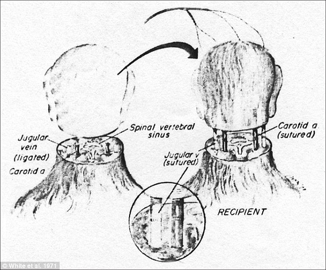 Lịch sử: Năm 1970, tiến sĩ Robert White cấy ghép đầu của một con khỉ vào cơ thể của người khác, như thể hiện trong sơ đồ này. Nếu người đứng đầu của ông Spiridonov đã được cấy ghép thành công tĩnh mạch cổ và dây cột sống sẽ phải được hợp nhất tương tự với những người thân của các nhà tài trợ mới của mình