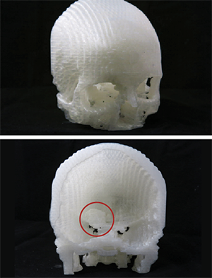 This 3D print helped doctors plan a new, minimally-invasive surgery to remove Scott&apos;s meningioma.
