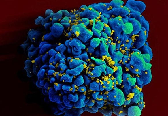Hình ảnh các hạt HIV tấn công một tế bào của người.