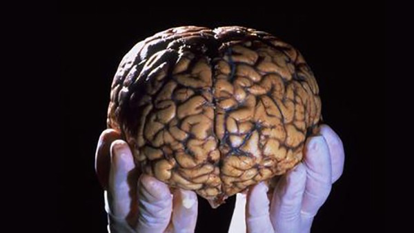 Con người hoạt động thế nào nếu bộ não chỉ có một nửa 4