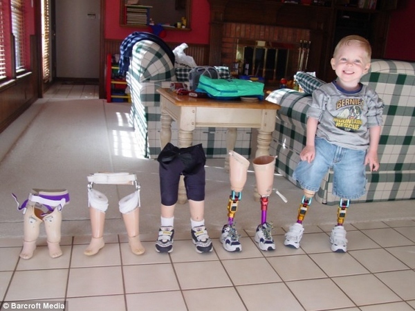 Những bộ phận cơ thể giả đang giúp đỡ nhiều cho người khuyết tật.