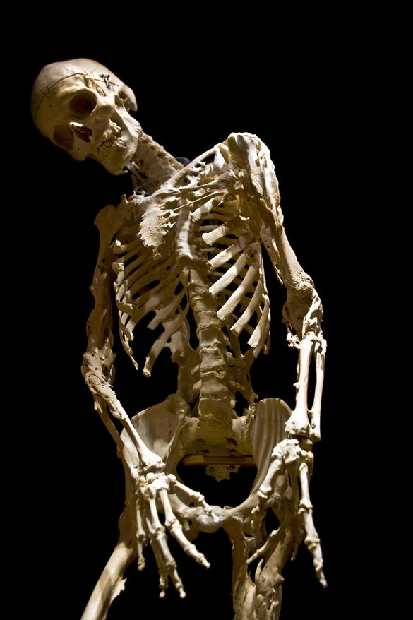 Bộ xương của người mắc bệnh FOP tại bảo tàng Mutter.