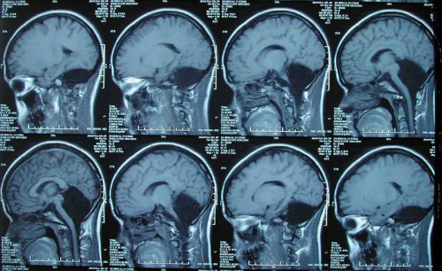 Ảnh chụp X-Quang chứng vô tiểu não nguyên phát