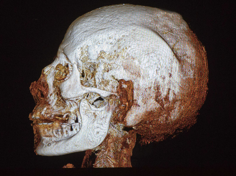  Chụp CT cho thấy người này mắc nhiều chứng bệnh như loãng xương, sâu răng và sụt lợi. 