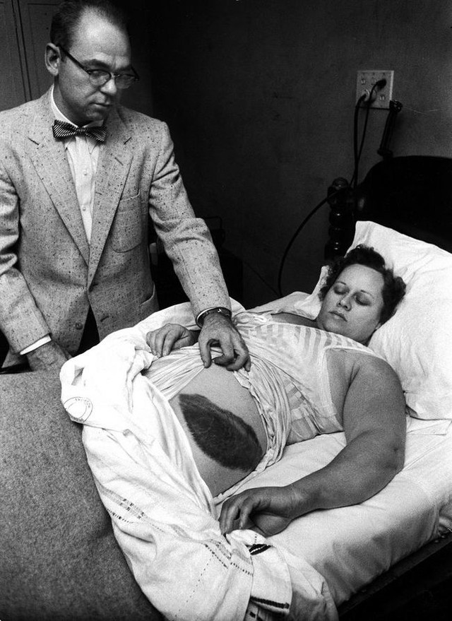 Ann Hodges là người duy nhất trong lịch sử bị thiên thạch đâm trúng, nó để lại một vết bỏng lớn trên người của cô (năm 1954).