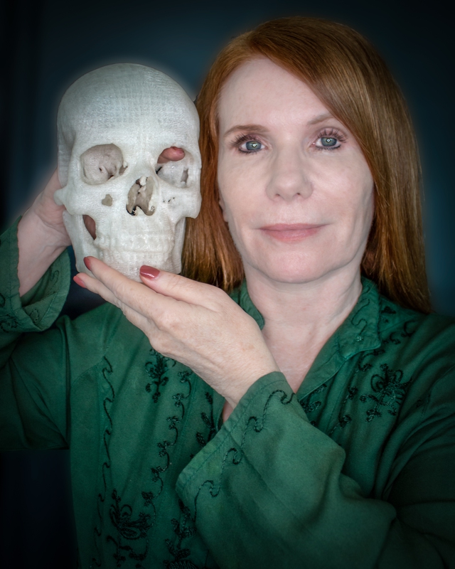Pamela Shavaun Scott, with a 3D printed copy of her own skull. Her right index finger is indicating the location of the meningioma she had removed.