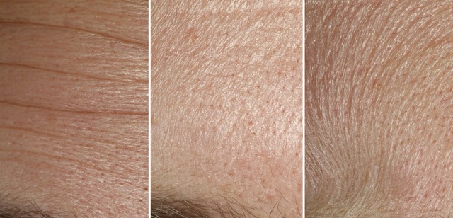 Ba hình dạng lớp da trên trán người khi biểu lộ cảm xúc ngạc nhiên (ngoài cùng bên trái), bình thường (ở giữa) và bối rối (ngoài cùng bên phải).