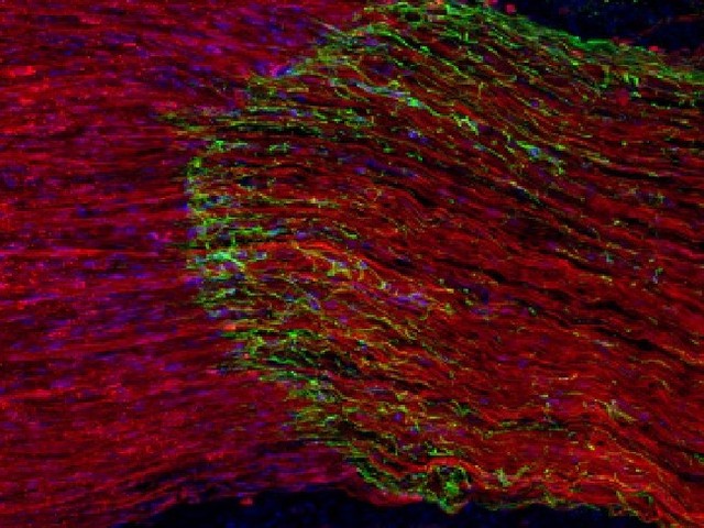 
Các vi khuẩn B. pseudomallei (màu xanh) di chuyển trong các dây thần kinh sinh ba (màu đỏ)
