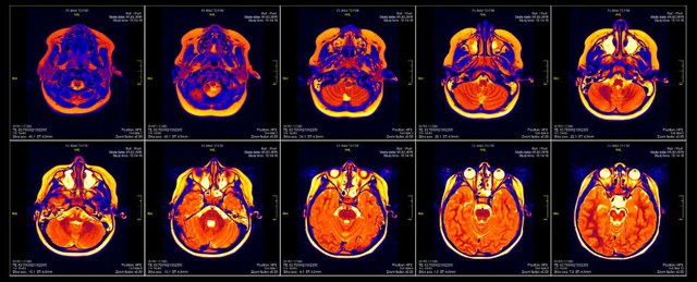 Hình ảnh não bộ qua máy quét cộng hưởng từ MRI.