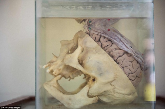  Hình ảnh của cả hộp sọ và não người trong bình. 