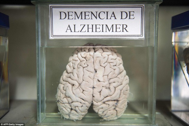  Não người mắc Alzheimer được trưng bày. 