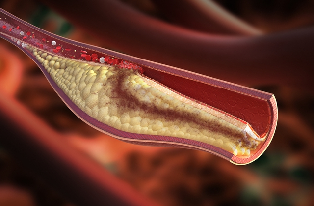  Cholesterol tích tụ làm hẹp động mạch gây bệnh tim và đột quỵ 