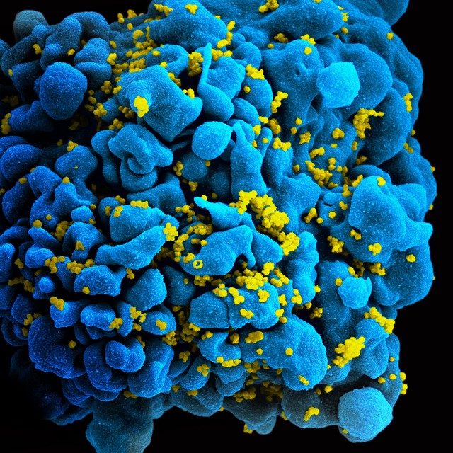  Hình ảnh một tế bào bị nhiễm HIV. 