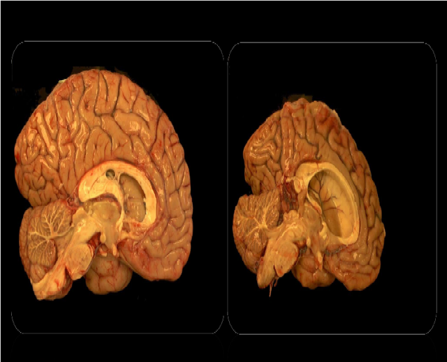  HÌnh ảnh bộ não bình thường (bên trái) và bộ não bị bệnh Huntington 