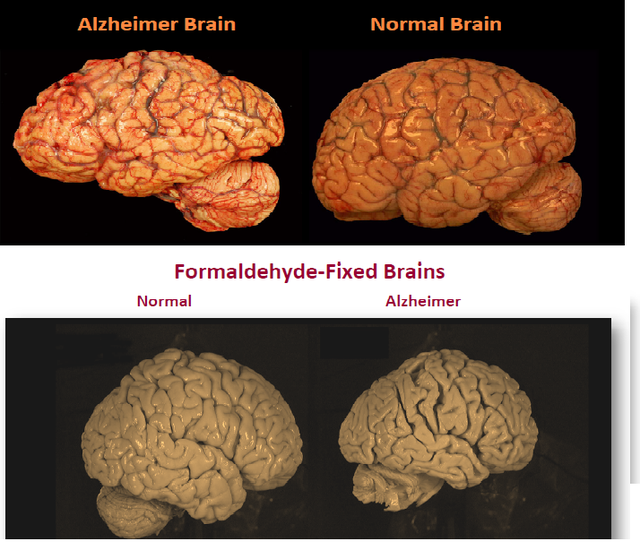  HÌnh ảnh bộ não bình thường và bộ não bị bệnh Alhzeimer cho thấy bộ não bị bệnh nhỏ hơn và bị teo lại. 