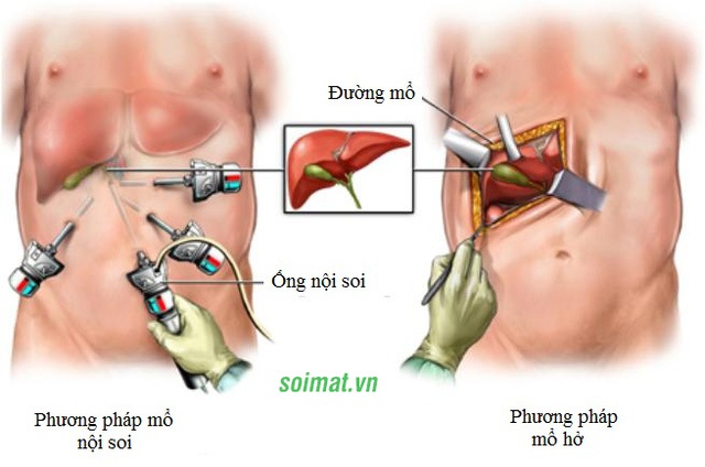  Đây là hai phương pháp phẫu thuật túi mật phổ biến hiện nay 