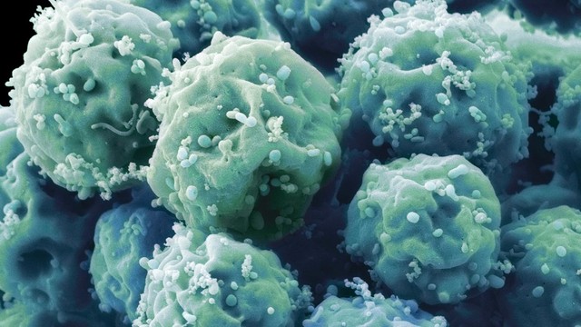 
Ít nhất 5 dòng tế bào gốc tại Mỹ đang chứa đột biến gây ung thư
