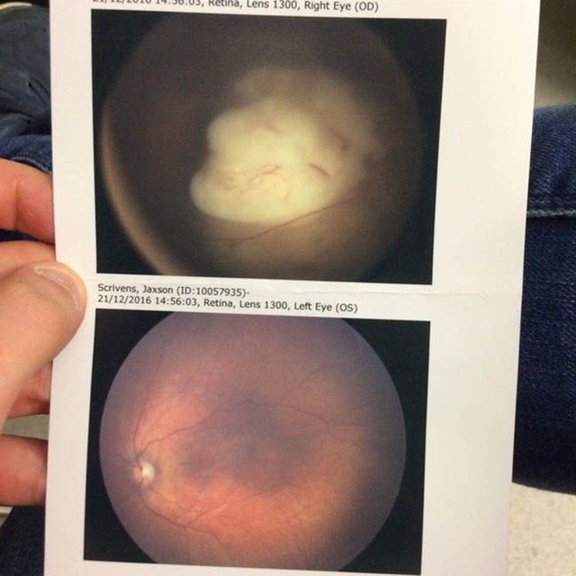  Ảnh chụp khối u trong mắt của Jaxson 
