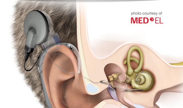  Ốc tai điện tử có thể cho phép những người khiếm thính nghe được 