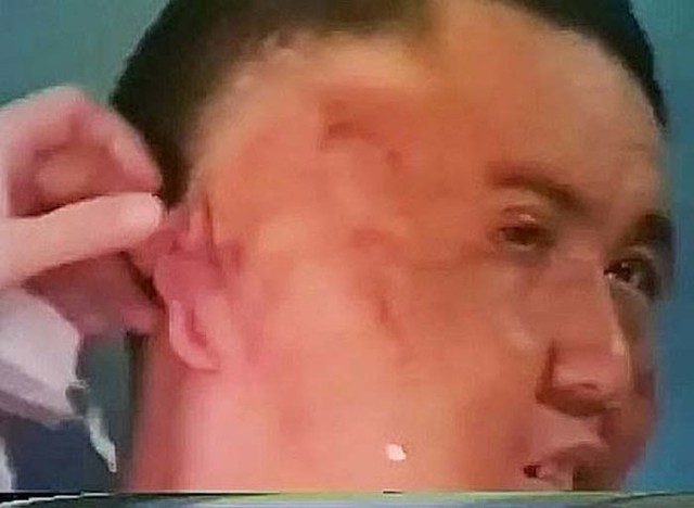  Hình ảnh Chang Tzu Ping sau khi phẫu thuật loại bỏ khuôn mặt thứ hai 