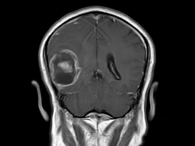 Glioblastoma là một dạng u não đặc biệt ác tính, bệnh nhân có tiên lượng trung bình chỉ 15 tháng 