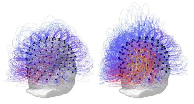  Tín hiệu trong não bộ người đàn ông trước (bên trái) và sau (bên phải) khi thực hiện liệu pháp - mô phỏng điện não đồ 