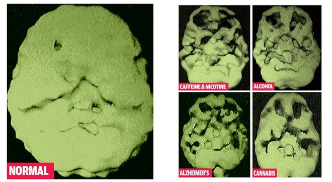  Hình ảnh so sánh não bộ của người sử dụng cà phê thường xuyên với não bộ của người bình thường và có tiền sử bệnh lý khác nhau 