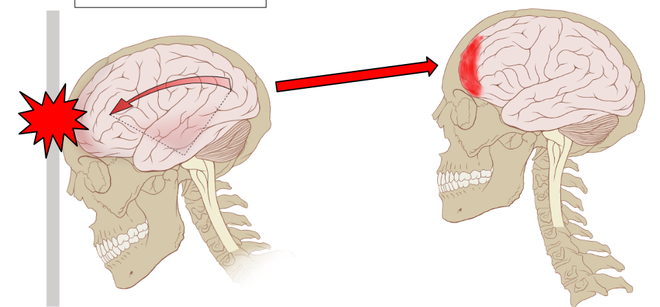  Về mặt lý thuyết, chúng ta không thể loại trừ khả năng đập đầu gây chấn thương sọ não rồi dẫn đến tử vong 